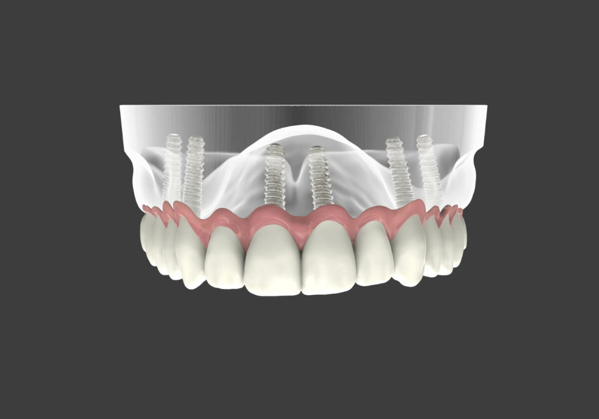 Dental Implants and Oral Surgery | Impressions Dental Care Doncaster