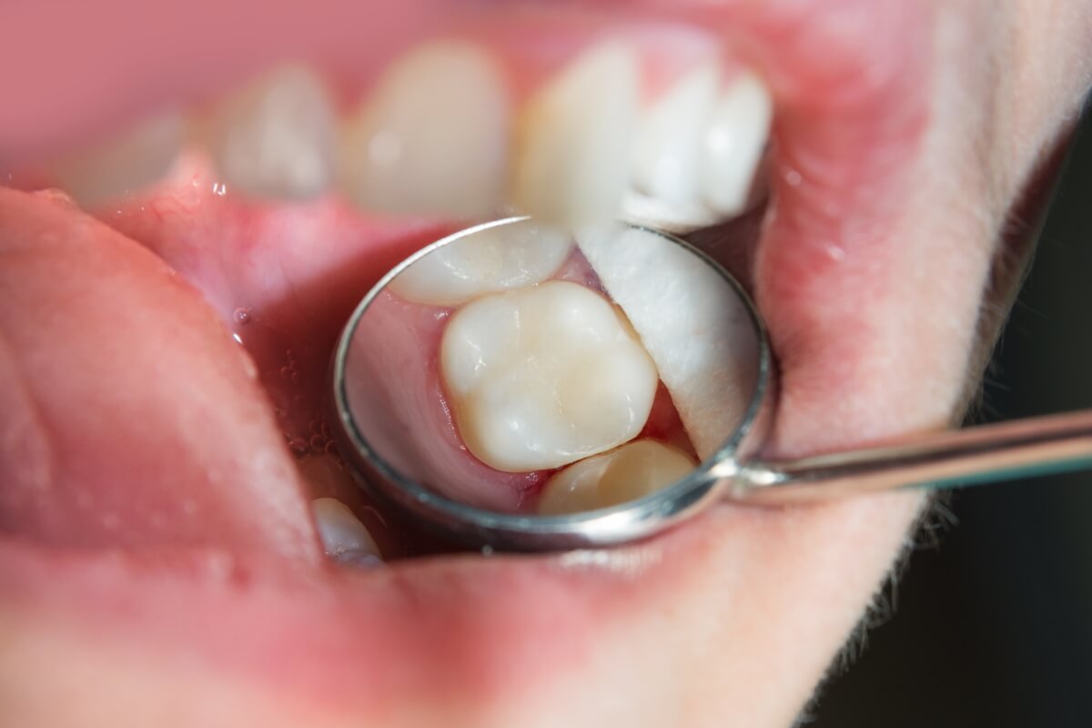 Featured image for “White Fillings”
